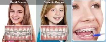 孙杨矫正牙齿前后,孙杨的牙齿是如何整形的