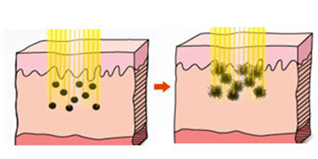 褐斑怎么治疗有效,褐斑怎么治疗效果最好