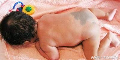 宝宝一出生脸上有一块褐色的胎记,宝宝一出生全身黑胎记