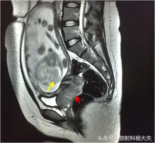 孕期同房，阴道少量流血，你能想到最坏的可能是什么？