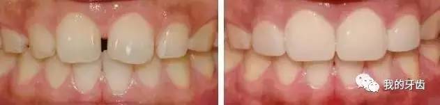 冷光美白牙齿靠谱吗,牙齿美白全过程视频