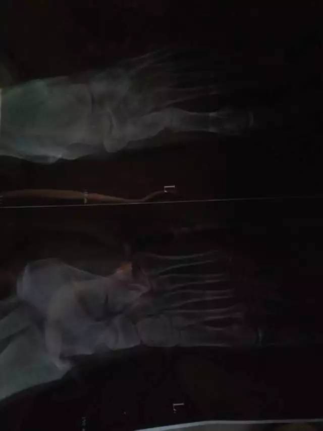 腱鞘炎需要停止打球吗,腱鞘炎问答