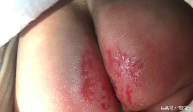 宝宝红屁股怎么预防图,宝宝预防红屁股的方法