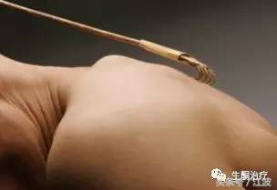 生酮过程皮肤瘙痒怎么办,生酮浑身痒