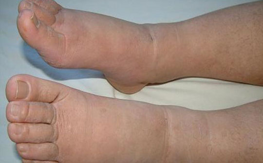 患上糖尿病有腹泻的症状吗,糖尿病有什么症状和表现55岁男人