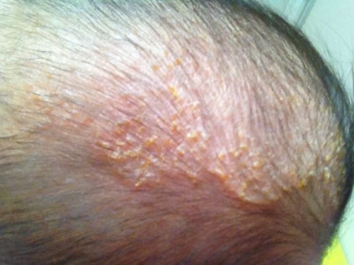 宝宝湿疹头顶黄痂可以自愈吗,婴儿头顶湿疹结的黄痂怎么才能掉