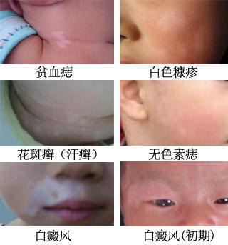 微科普——白癜风疾病的诊断标准