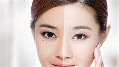 激光祛斑前你需要了解这些才能更好祛斑