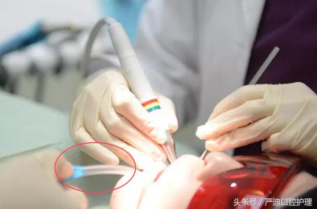 洗牙时管子能吸走牙结石么,洗牙为什么要放根管子