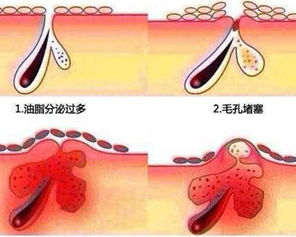 为什么来姨妈会长痘痘,为什么额头会长痘痘