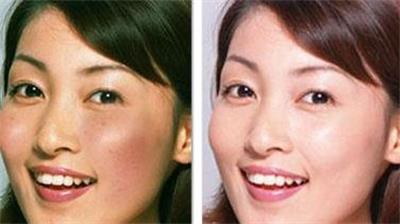 药水祛雀斑好还是激光祛雀斑好,激光祛雀斑最有效的方法