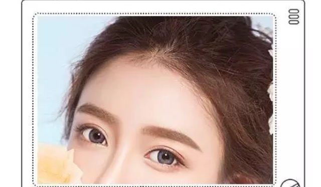 做双眼皮一个星期后感觉太宽了,第一次做双眼皮太窄了