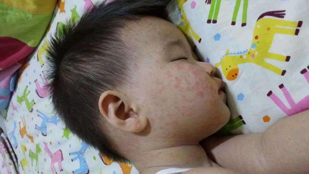 宝宝发烧后长疹子是怎么回事,小孩子发烧脸上长疹子怎么办