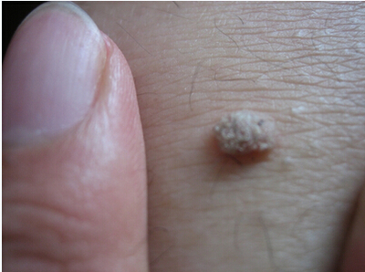 扁平疣和寻常疣和瘊子的区别,寻常疣扁平疣都是瘊子吗