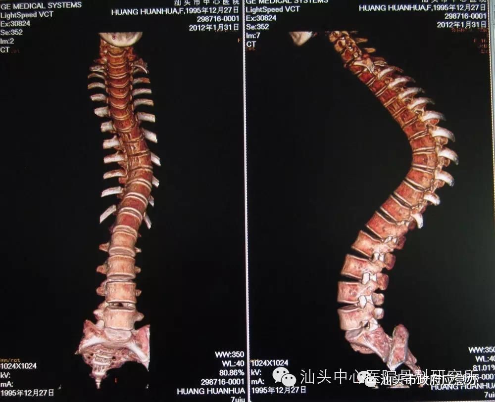 脊柱畸形可以申请补助吗,先天性结构畸形贫困能申请救助吗