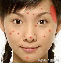 关于痘痘肌肤应该如何护肤,关于痘痘治疗方法