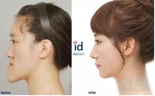 韩国整容手术恢复过程,韩国一个整容的综艺节目