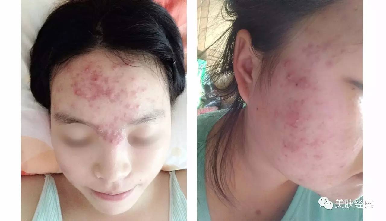 痘友用什么产品最好,爱长痘的人要避免哪些食物