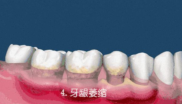 洗完牙后牙齿松动怎么办,烂牙洞疼痛造成牙齿松动