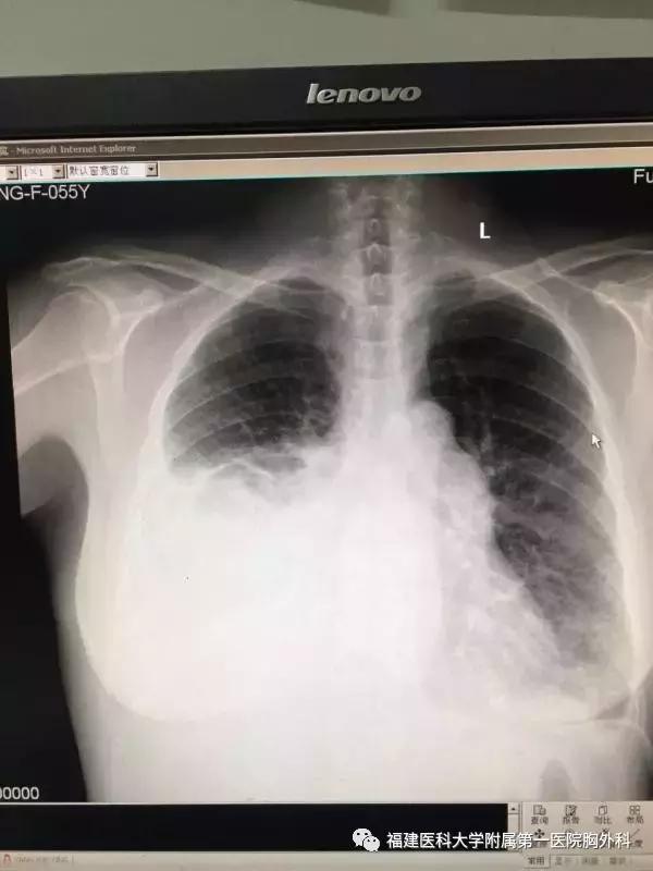 胸外科乳糜胸,乳糜胸的外科治疗