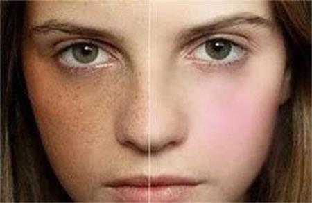 敏感肌肤能用激光吗,敏感肌肤能做激光祛斑吗