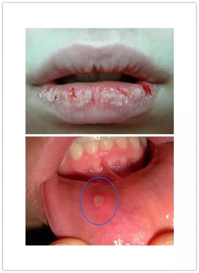 火不可乱降,上火应该做什么?