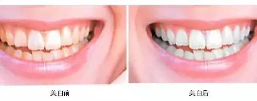 牙齿黄又丑又尴尬,牙齿黄笑的难看怎么办