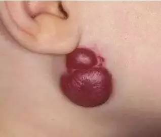 初生婴儿痣和胎记怎么区别,孩子长痣和胎记区别