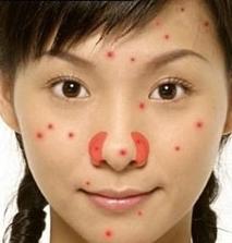 脸上长痘痘是什么原因一碰就疼,脸上长痘痘是什么原因怎么解决