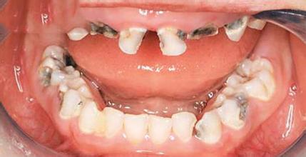 小孩乳牙蛀牙做根管治疗还是拔牙,小孩乳牙有蛀牙洞要治疗吗