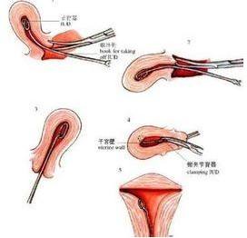 上环和取环的区别亲身经历,上环取环的相关知识