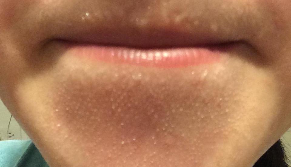 下巴有肉刺是什么病,下巴下面长很多小白点像白粉刺