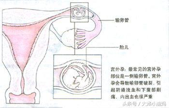 孕早期肚子疼有什么缓解,孕早期肚子疼有什么解决办法
