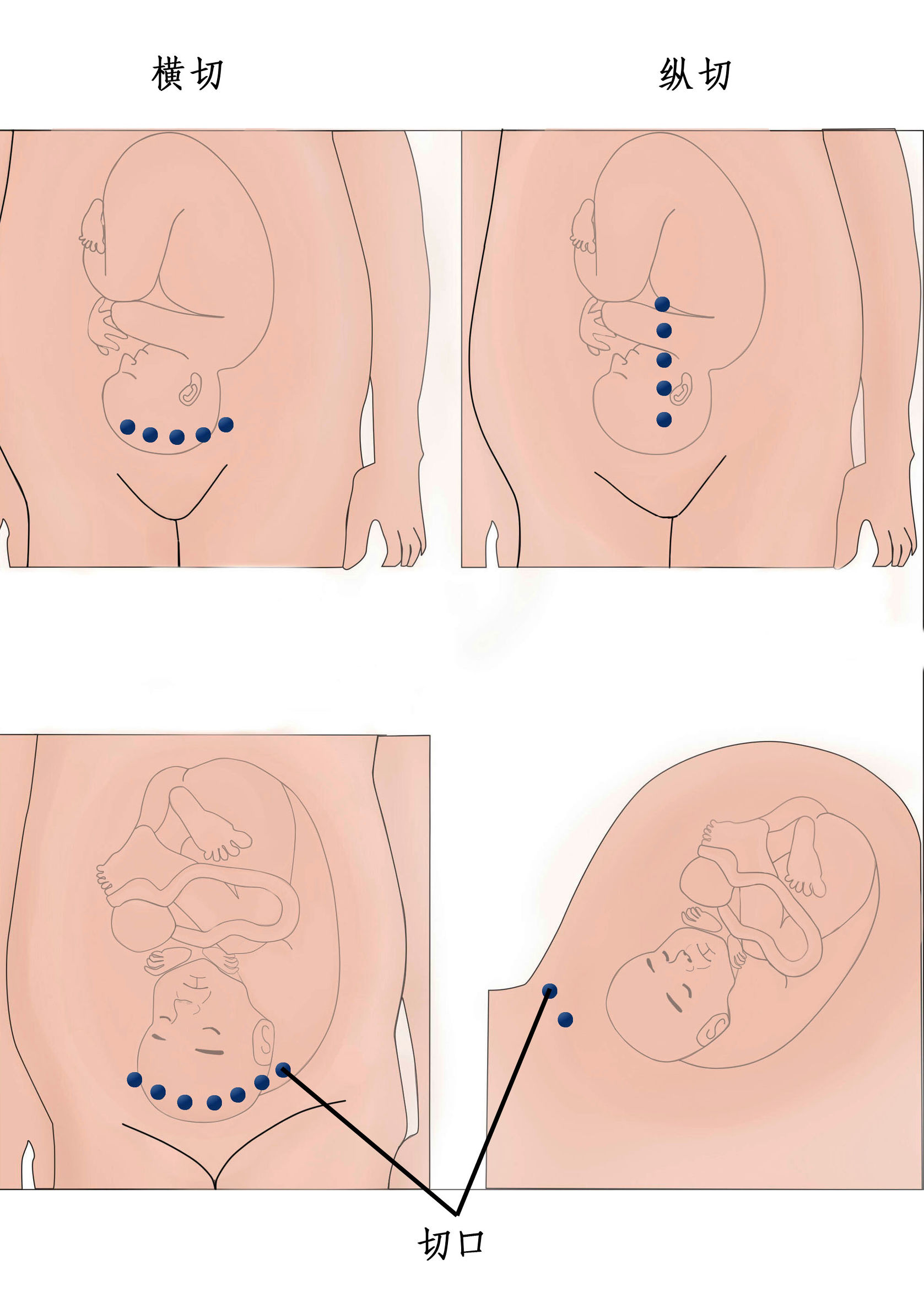 剖腹产挨几刀,剖腹产需要开几刀