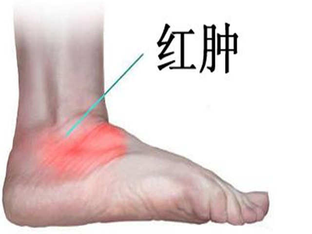 踝关节扭伤了热敷会怎么样,足踝扭伤后冰敷后怎么调理