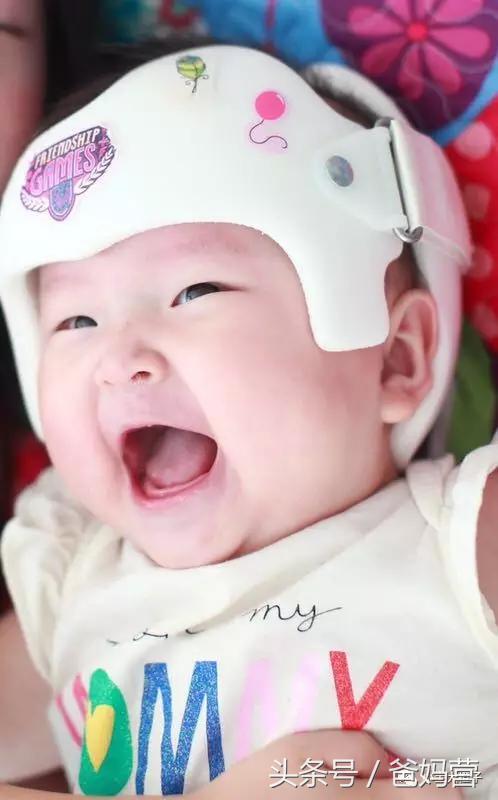 美国的宝宝扁头为什么要矫正,扁头在国外要做矫正吗