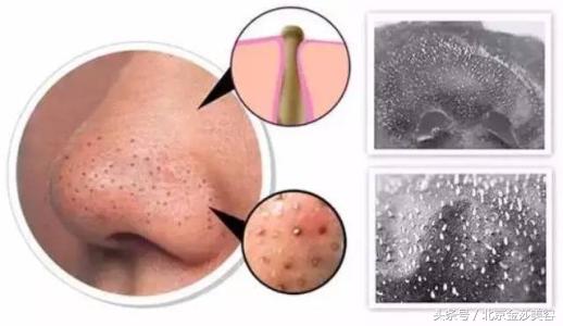 怎么正确挤黑头步骤,正确挤黑头的方法