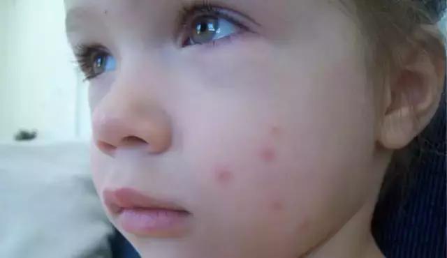 被蚊子咬了擦什么药,被蚊子咬了擦酒精有用吗