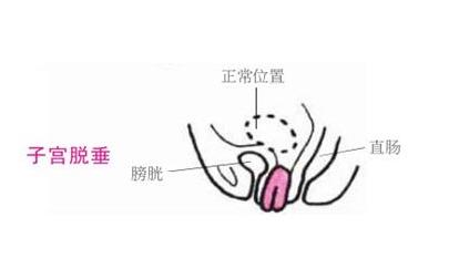 尴尬！产后咳嗽憋不住尿是怎么回事？