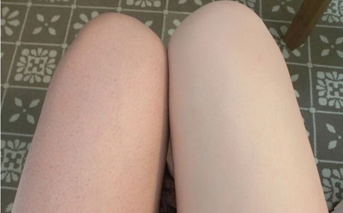 学生党腿上鸡皮肤怎么去除,如何去除鸡皮肤小窍门