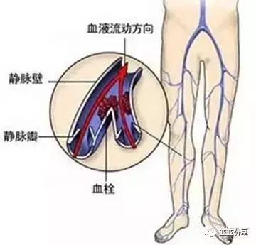 精索静脉曲张艾灸灸哪个穴位,静脉曲张可以艾灸足三里吗