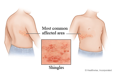 压疮久治不愈后果,身体压疮怎么治疗