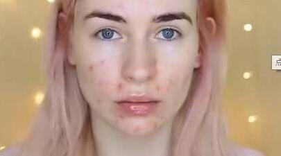 我要问名医-面部*疮痤**不断，红色疙瘩鼓起微疼，该怎么办？