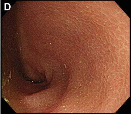 腹泻的不同类型及病例,腹泻的不同原因及现象