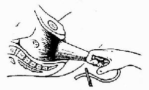 第6版妇产科护理学,第71课