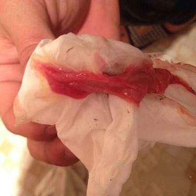 产后2个月恶露不净反复出血,产后40天恶露反复