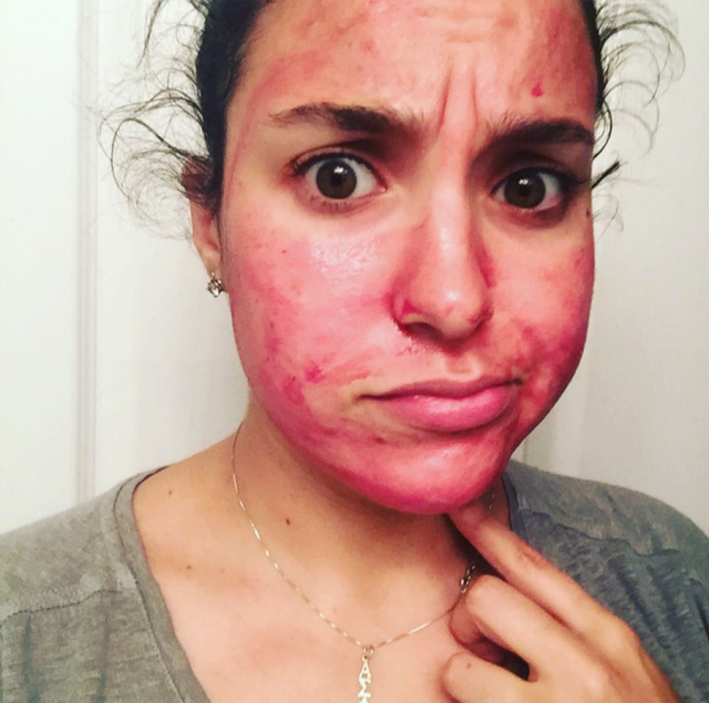 怎样才能祛痘去黑头去闭口,祛痘去黑头粉刺闭口