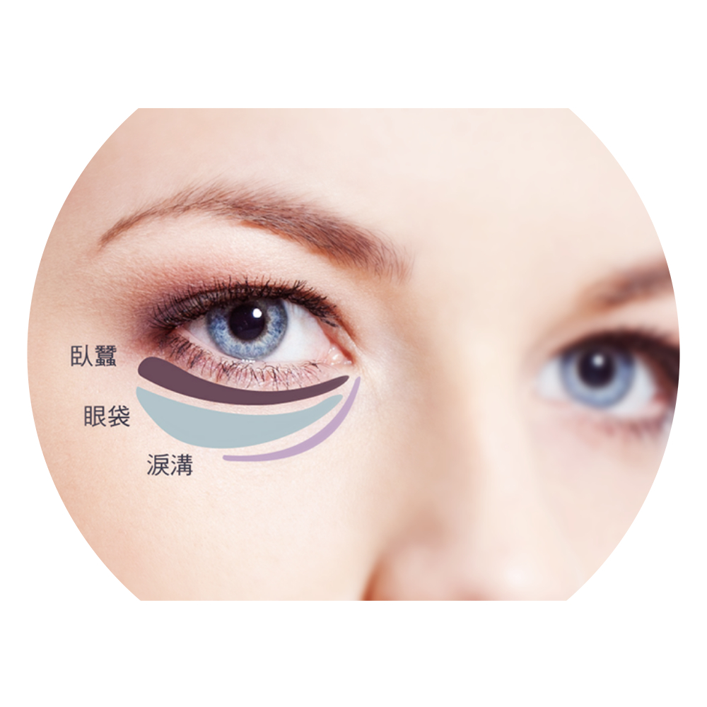 眼袋纹是怎么形成的原因,眼袋形成的原因及解决
