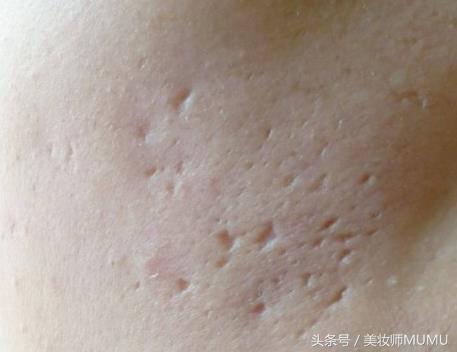 痘坑等于毁容！能修复得好吗？