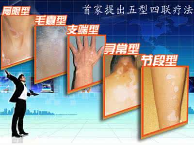 身上的白癜风白斑是怎么去治疗的,怎么检测身上的白斑是不是白癜风